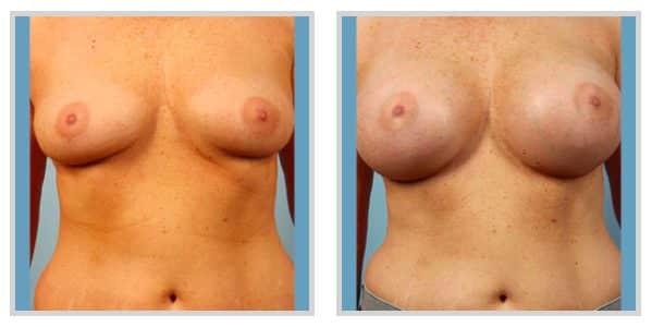 Breast Augmentation Before and After Photos