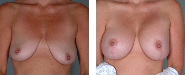 Before and After Photos of a Breast Augmentation with Breast Lift
