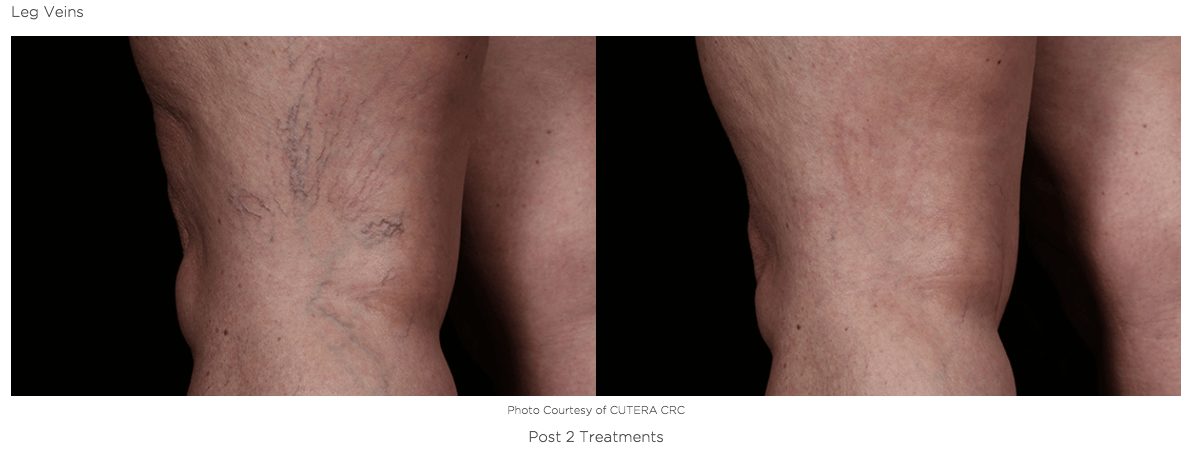Before & After Photos of Laser Treatments for Spider Veins