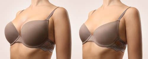 Breast Implant Removal Without Replacement