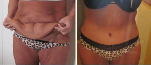 Before and After Photos for Tummy Tuck Surgery