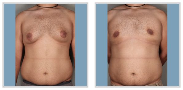 Is There a Non-Surgical Way to Get Rid of Gynecomastia?