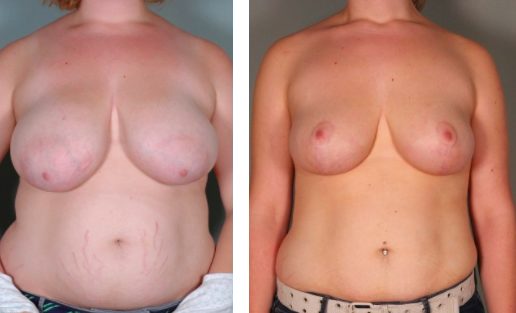 A Breast Lift for Large Breasts