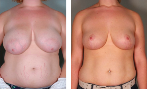 Breast implants and big nipples A Breast Lift For Large Breasts North Shore Aesthetics