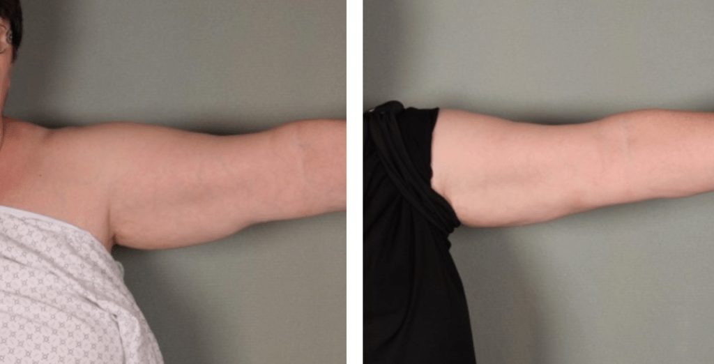 Arm Lift Before and After Photos