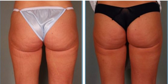 Cellulaze Treatment for Cellulite Before and After Photos