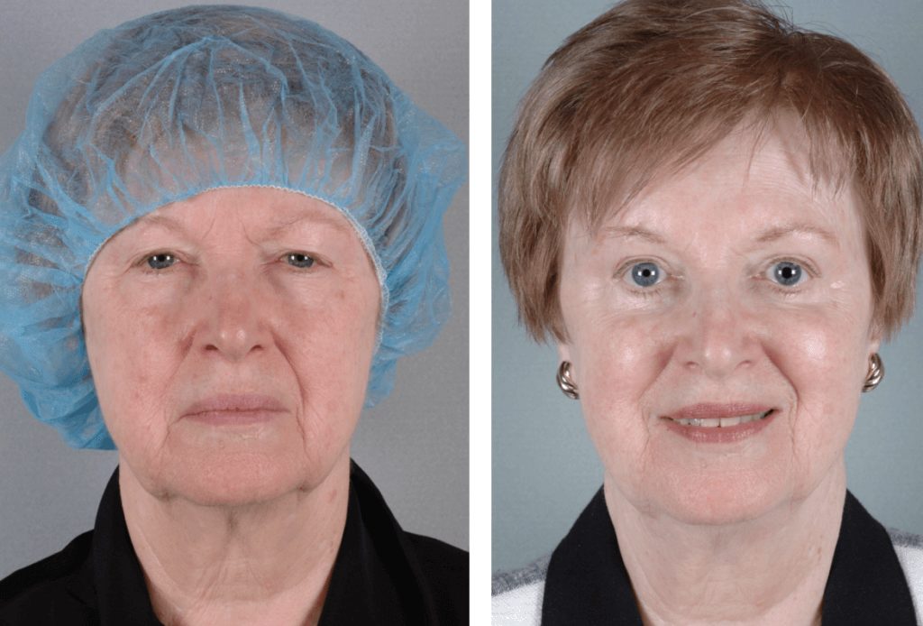 Upper Eyelid Surgery Before and After Photos