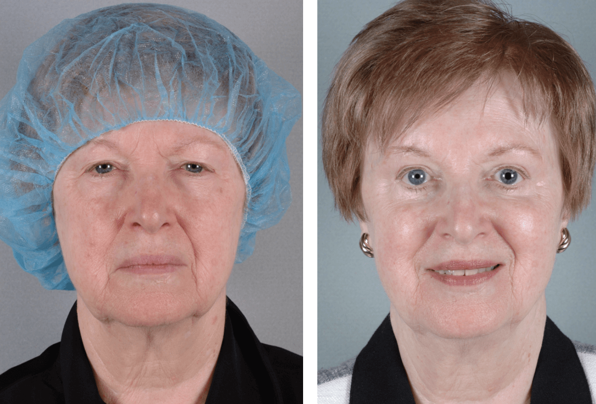 Droopy Eyelid Surgery Before And After Pictures