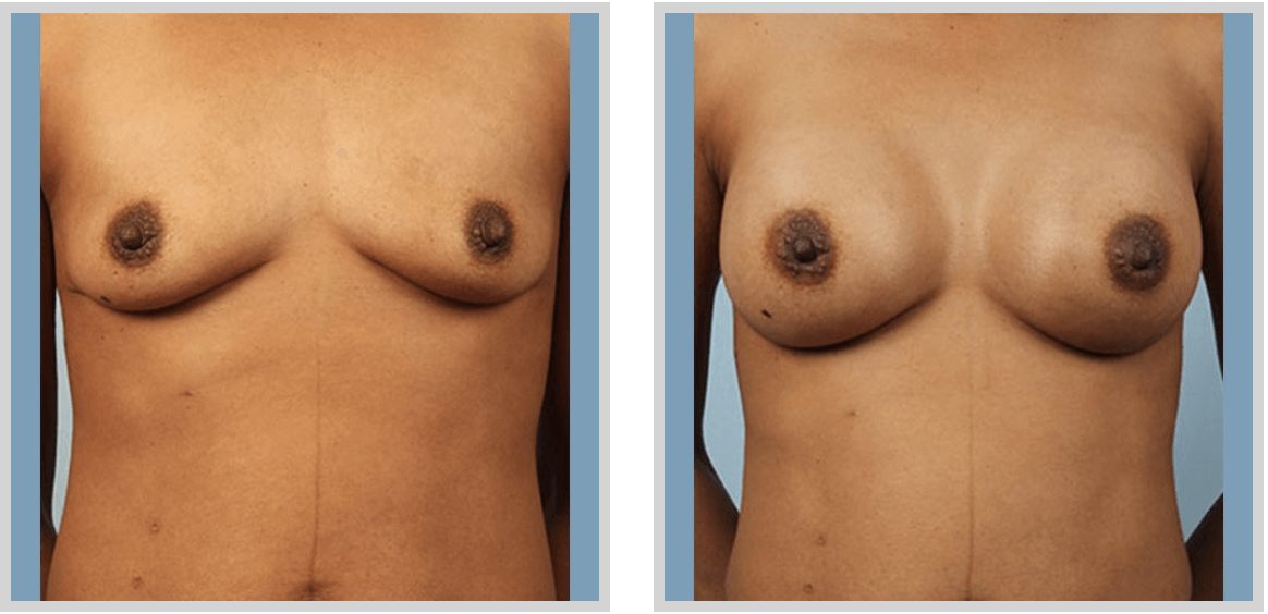 Breast Augmentation Before and After Photos