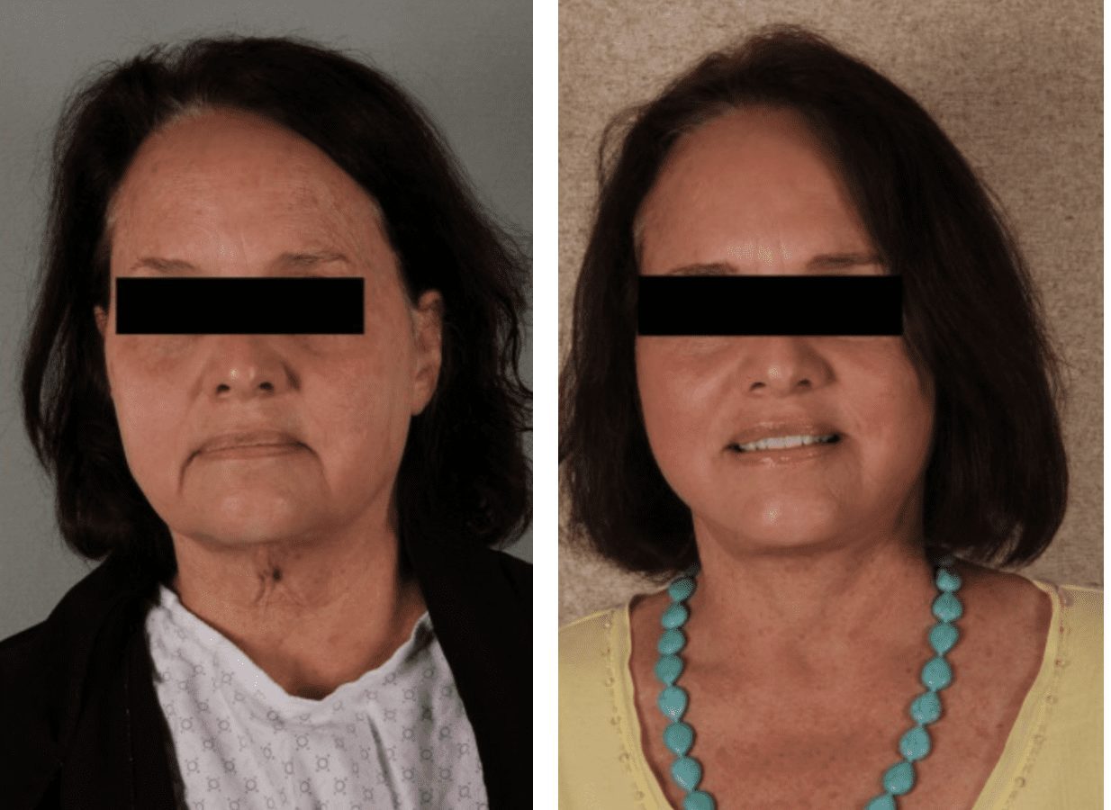 Facelift Before and After Photos