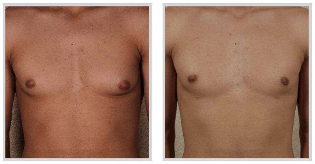 Gynecomastia Surgery Before and After Photos