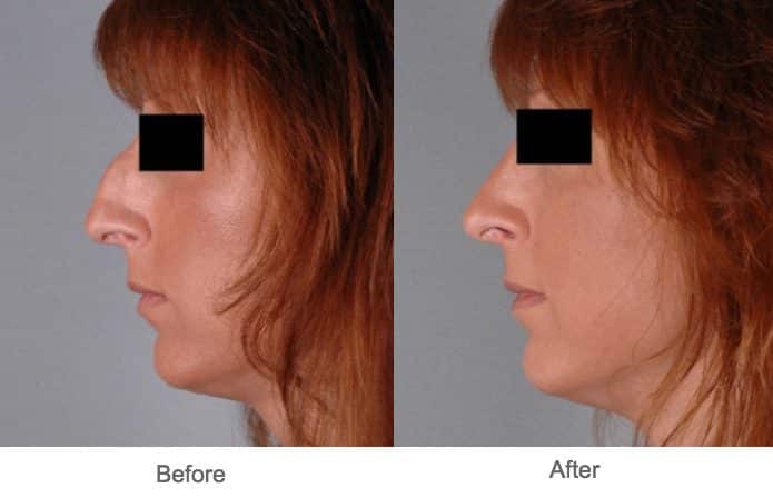 Austin Rhinoplasty Surgery