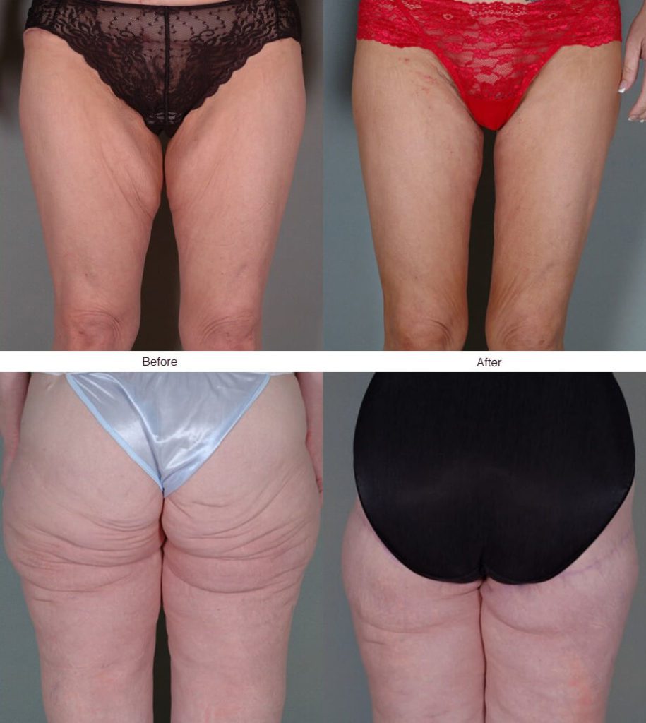 Thigh Lift Surgery, Chicago, IL