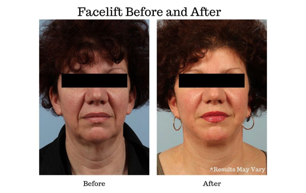 Before and after photos of a patient who underwent facelift surgery with Dr. Schlechter.