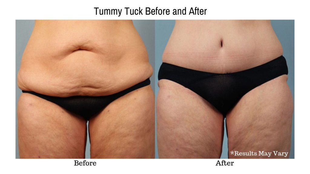 Before and after image of a patient who underwent tummy tuck surgery (abdominoplasty).