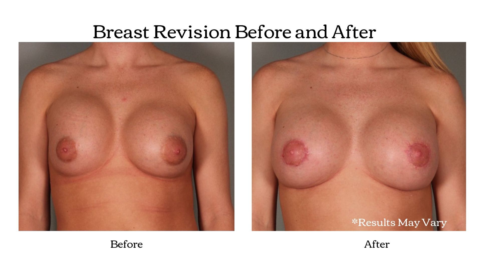 Before and after images of a patient who underwent breast revision after her breast augmentation to correct capsular contracture.