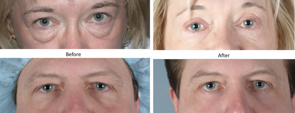Dr. Schlechter - Blepharoplasty (Eyelid Surgery) Before and After Photos