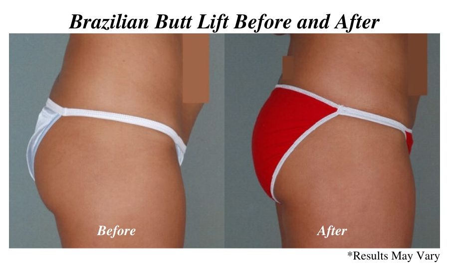 Before and after image showing the results of a Brazilian Butt Lift performed in Chicago, IL.