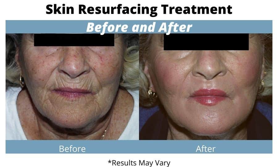 Before and after image showing the results of a laser skin resurfacing performed at North Shore Aesthetics in Chicago, IL.