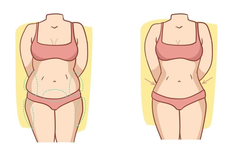 scarless tummy tuck before and after