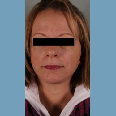 After Image