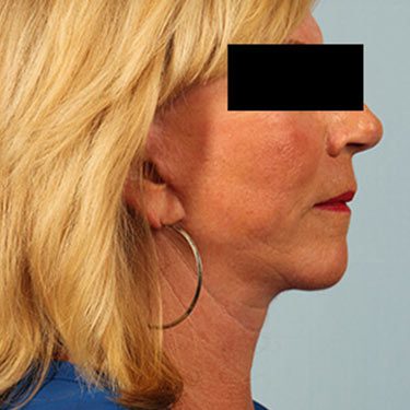 After Image