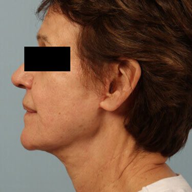 After Image